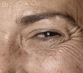 Non-surgical facial volume restoration treatment improving hollow cheeks and under-eye areas